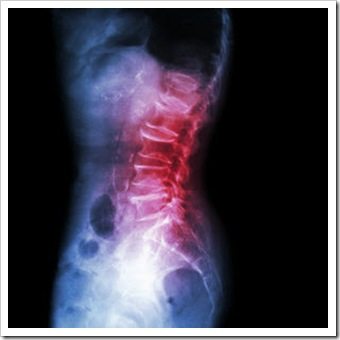 Back Pain Valdosta GA Arthritis