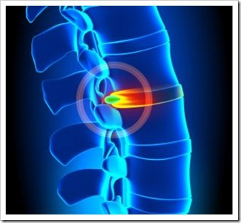 Back Pain Valdosta GA Spinal Decompression