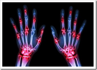 Rheumatoid Valdosta GA Arthritis Solutions