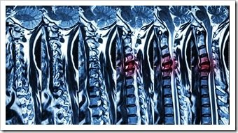 Back Pain Rehab Valdosta GA Spinal Surgery