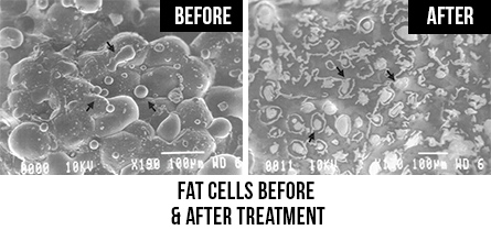 Fat cells before & after treatment